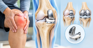 Partial Knee Replacement